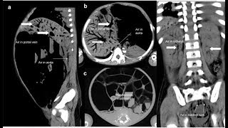 Pneumatosis intestinalis und tödliche portosystemische Luftembolie [upl. by Ettennan884]