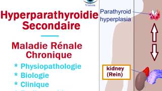 Hyperparathyroidie Secondaire et maladie Renale Chronique [upl. by Aleinad]