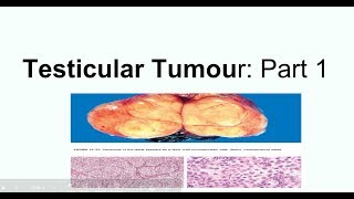 Seminoma Clinical picture Morphology and staging [upl. by Kelci807]