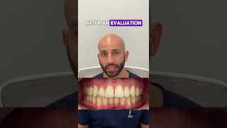 Spacing and overbite correction analysis [upl. by Ynatsyd]