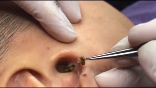 UNBELIEVABLE PIERCING OF BLACKHEAD IN THE EAR SATISFYING VIDEO [upl. by Mclyman636]