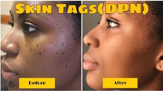 BEFORE AND AFTER DERMATOSIS PAPULOSA NIGRA REMOVAL RESULTS IN 1 WEEK  VIDEO  PHOTOS INCL [upl. by Spancake145]