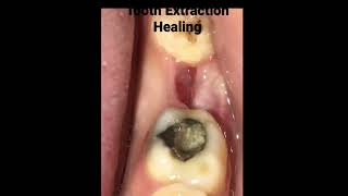 Tooth extraction healing Timelapse [upl. by Eanil85]