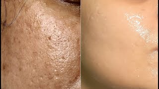 How to get rid of Large OPEN PORES with ice cubes massage [upl. by Adialeda]