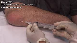 Olecranon Bursitis  Aspiration and Injection  In Vivo Series [upl. by Prince]