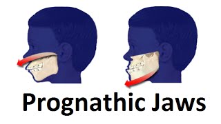 Treatment of Prognathic Jaw Jaw Pushing Forward by Prof John Mew [upl. by Alac893]