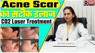 Acne Scar Treatment Fractional CO2 Laser  La fameux Derma। National Health [upl. by Tlihcox666]