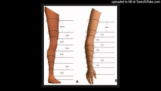 Evaluation of lymphedema in upper extremities by MR lymphangiography Comparison with lymphoscintigr [upl. by Ydoow]