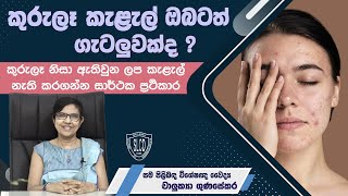 How to treat Acne Pimple Scars කුරුලෑ ලප කැළැල් ඉවත් කරගමු  Dr Chalukya Gunasekara skincare [upl. by Rosalba675]