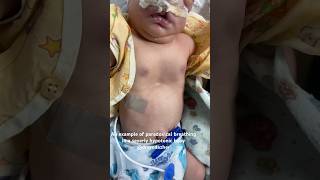 Paradoxical breathing baby cutedoctor babymilk reels cute cutebaby india kashmir america [upl. by Nileuqcaj199]