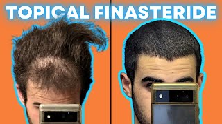 Topical Finasteride The Perfect Hair Treatment No One Talks About [upl. by Lamoureux265]