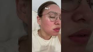 My journey  Co2 laser and Subcision Before and after co2laser acnescars facial treatment [upl. by Landahl734]