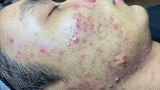 ACNE TREATMENT VU QUYNH MI  Blackheads On Boy Face 2024FULL [upl. by Leal]