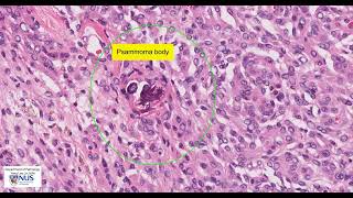 Meningioma meningothelial microscopy  Talking slide [upl. by Chambers]