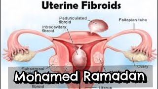 fibroid dr m ramadan [upl. by Eerol]