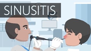 What is Sinusitis [upl. by Joshuah686]