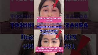 Ptoz korreksiyasi  қовоқ олиш  blefaroplastika Doctor ODILJON 998974347791 TOSHKENT VA JIZZAXDA [upl. by Annaihr]