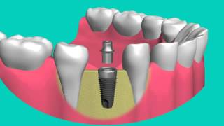 Si vous avez subi la perte dune dent Implant dentaire est la meilleure solution [upl. by Kalmick]