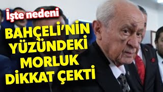 Oyunu kullandı Devlet Bahçelinin yüzündeki morluklar dikkat çekti [upl. by Koorb]