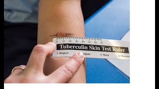 Tuberculin skin test or mantoux test or purified protein derivative test test for TB [upl. by Notsnhoj]