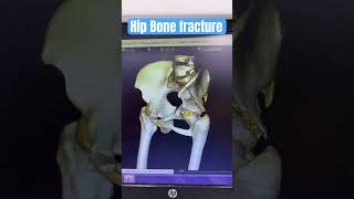 Hip Bone fracture shorts viralvideo hipbone [upl. by Rhine]