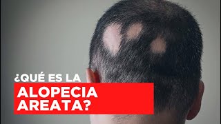 ¿Qué es la Alopecia Areata  TRATAMIENTO Y DIAGNÓSTICO [upl. by Nagem]