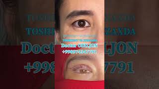 Qovoq olish  қовоқ олиш  blefaroplastika Doctor ODILJON 998974347791 TOSHKENT VA JIZZAXDA rek [upl. by Gillian798]