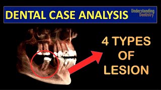 TRY TO DIAGNOSE A Case with 4 TYPES of PERIAPICAL LESIONS radicular cyst close to IAN Dental Quiz [upl. by Wrennie144]