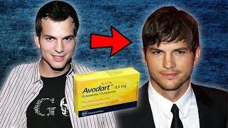 Ashton Kutcher Used Dutasteride For 10 Years To Keep His Hair [upl. by Riesman]