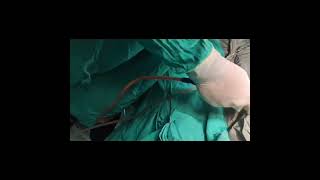 gynecomastia surgery in jaipur by Dr Anoop Sharma certified plastic surgeon [upl. by Eyot]