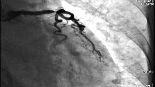 Distal LMCA Bifurcation stenting [upl. by Anairdna]