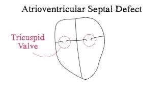 Atrioventricular Septal Defect AVSD [upl. by Lyreb]