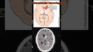 Intravascular hemorrhage  CT scan of brain  Brain hemorrhage shorts shortsfeed viralshort [upl. by Notyalk346]