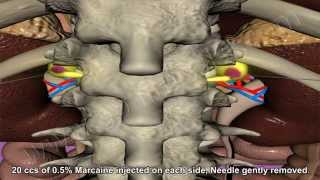 Celiac Plexus Block [upl. by Tyne540]