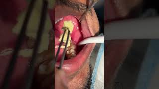 Dentigerous Cyst Surgical outcome l 07044611705 l Dr Arindam Mandal OMFS [upl. by Hannazus299]