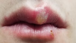 how to get rid of fever blisters in 1 day step by step [upl. by Lekkim]