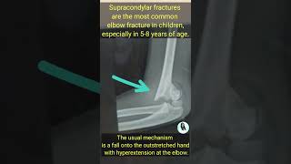 Supracondylar fracture of elbow  commonest fracture of children  gunstock deformity [upl. by Mieka]