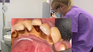 Smoker’s teeth cleaning  dental care  scaling [upl. by Teevens]