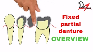 Fixed partial denture  Overview ENGLISH [upl. by Arraic]