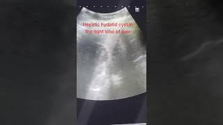 Hepatic hydatid cyst in the Right Lobe of Liver [upl. by Elish]