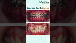 Crooked Teeth Braces shorts braces dentist [upl. by Woo]