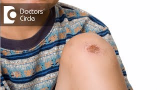 Causes amp management of scabs all over the body  Dr Rasya Dixit [upl. by Wren]