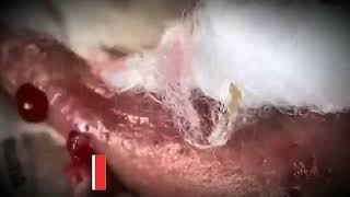 blackhead removal around lips  blackhead removal at home [upl. by Jaf]