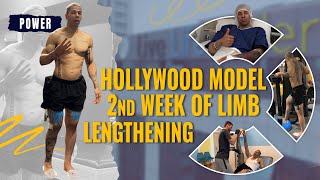 HOLLYWOOD MODEL 2ND WEEK OF LIMB LENGTHENING [upl. by Nolos]