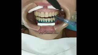 blanqueamiento dental [upl. by Pool]