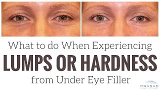 What to do When Experiencing Lumps or Hardness from Under Eye Filler [upl. by Hasseman]