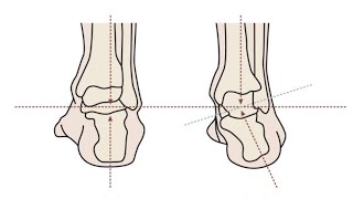 Guide How do I recognize that I have an everted ankle [upl. by Meehyrb501]