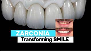 Zirconia before and after crowns Finally Revealed  zirconia teeth before and after  la dentist [upl. by Anertac32]