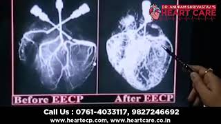 No Heart Surgery No Risk No Pain No Hospitalization for Blockage amp Weak Heart  Treatment By EECP [upl. by Grimaldi]