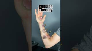 Cupping the Ulnar Nerve How to Trace and Treat Nerve Pain Effectively cubitaltunnelsyndrome [upl. by Rowland454]